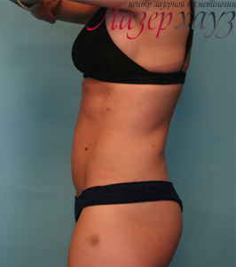 Coolsculpting by Zeltiq