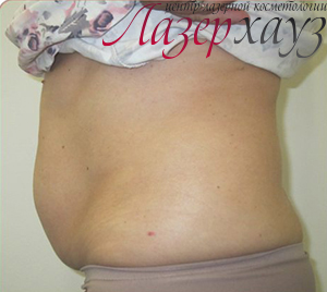 Coolsculpting by Zeltiq