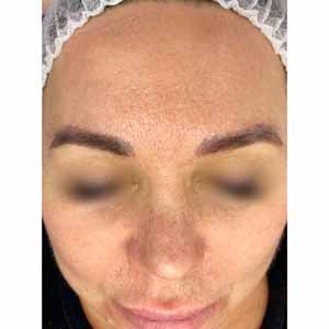 Комплексная чистка HydraFacial