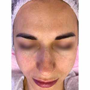 Комплексная чистка HydraFacial
