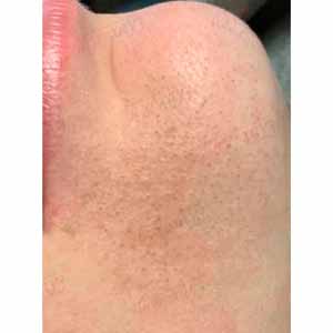 Комплексная чистка HydraFacial
