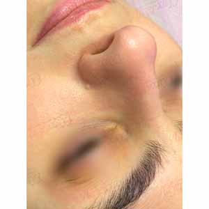 Комплексная чистка HydraFacial