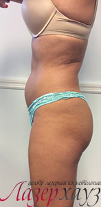 Coolsculpting by Zeltiq