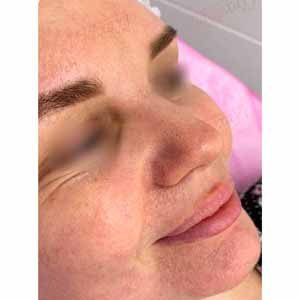 Комплексна чистка HydraFacial ТОП - Фото До - №7
