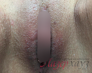 Контурная пластика половых губ в Харькове - Фото После - №1